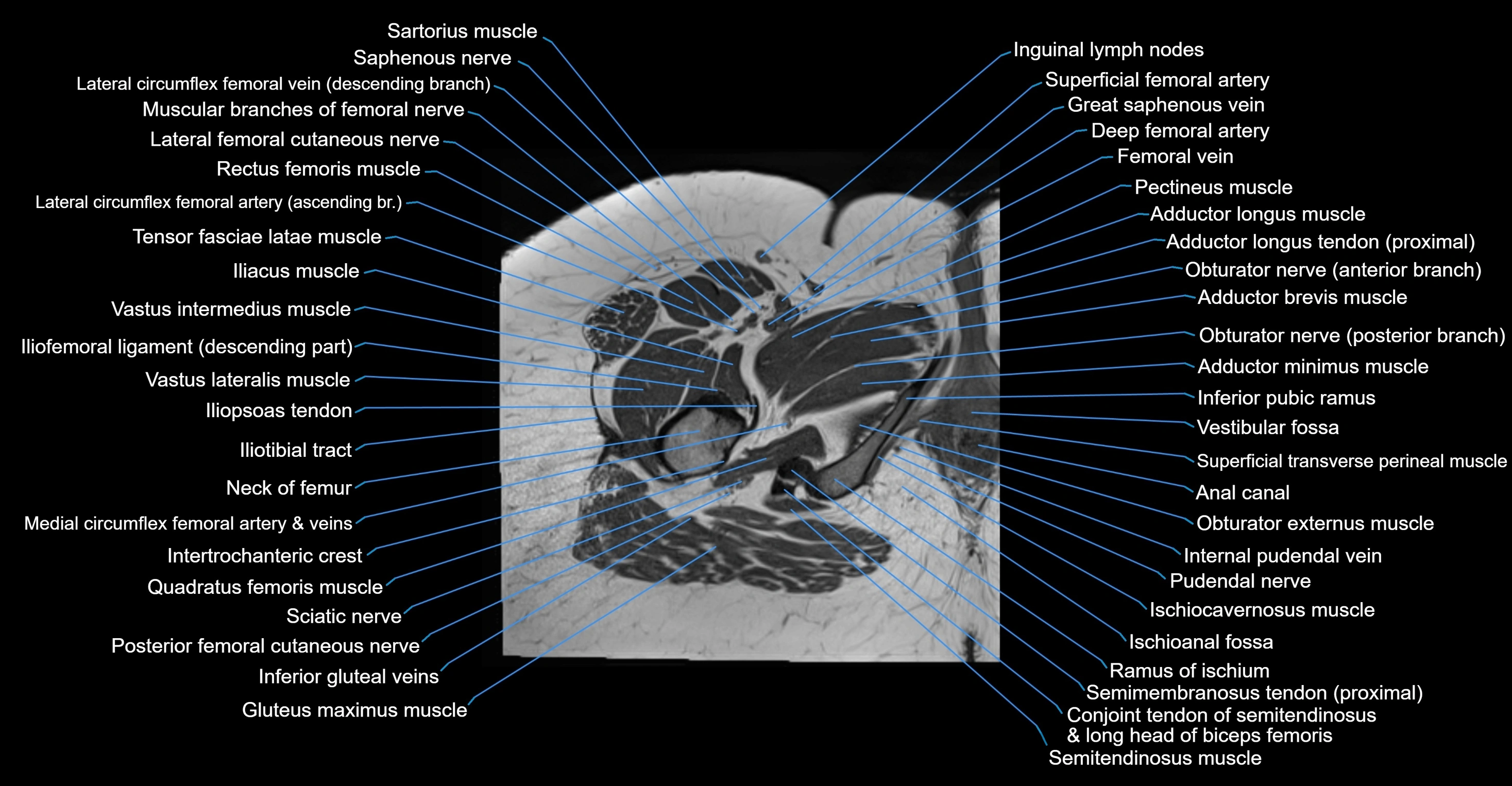 MRI hip axial cross sectional anatomy 3T 3D  radiology  anatomy image-img-00001-00065.webp